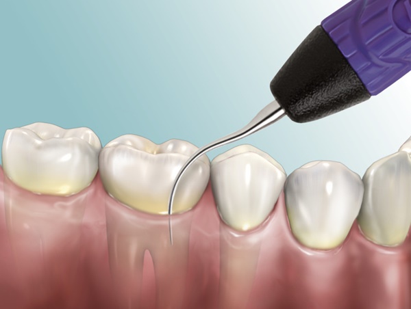 Tự kiểm tra vôi răng chẩn đoán bệnh gì? và hướng dẫn đọc kết quả